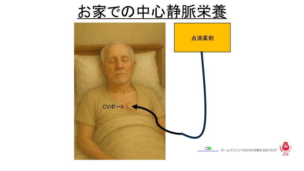 お家での中心静脈栄養
